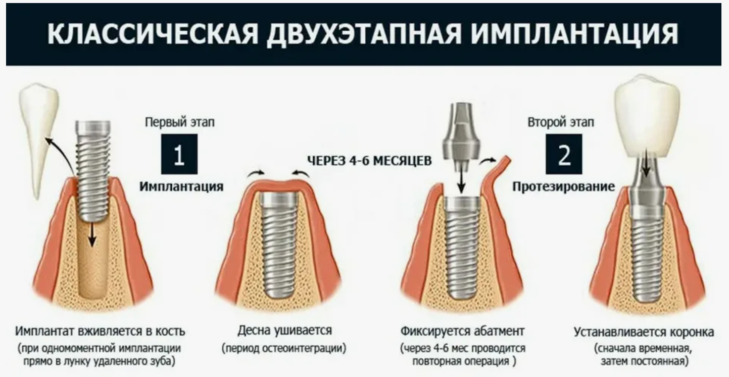 Имплантация зубов