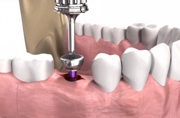  Установка формирователя десны