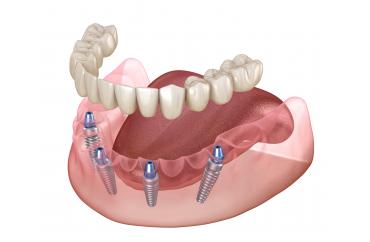 Несъемное протезирование зубов