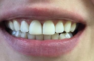 Художественная реставрация зубов