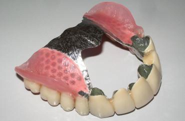 Бюгельный протез