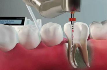 Лечение корневых каналов