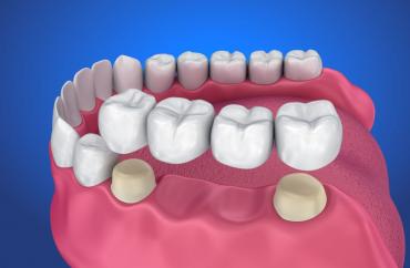 Мостовидные протезы (или зубные мосты) 