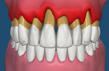 Лечение пародонтоза