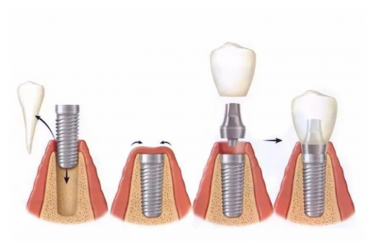 Немедленная нагрузка на имплантат (установка временной коронки)